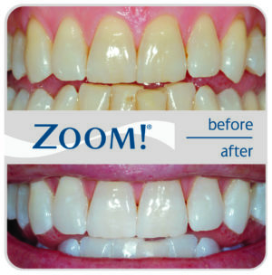What teeth whitening products actually work?