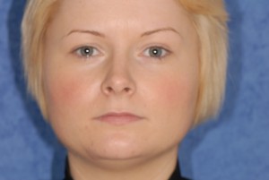 Robyn Juvederm