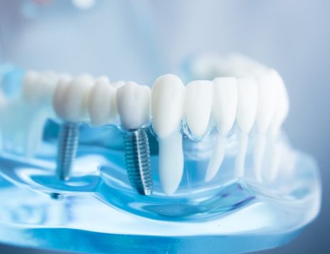 Reliable Solutions for Missing Teeth at Cherrybank Dental Spa