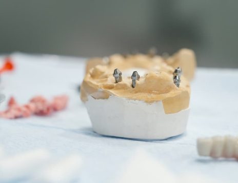 Preparing for Your All-on-4 Dental Implant Surgery