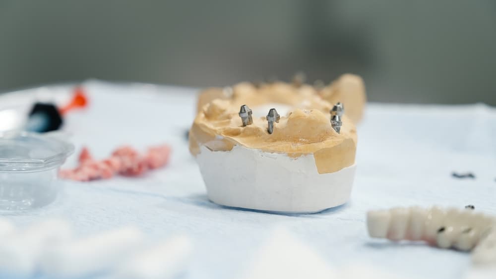 All-on-4 Dental Implants Perth